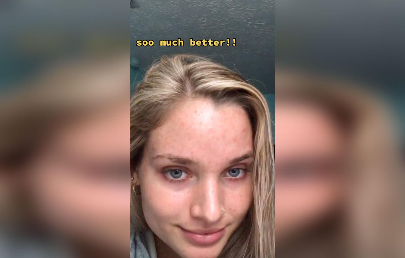 Bandages for acne? Experts weigh in on viral TikTok hack - ABC News