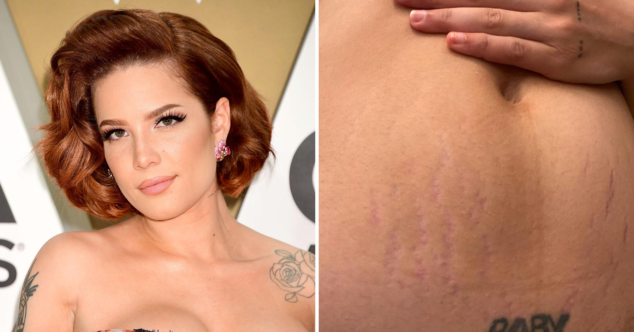 halsey shares photo of her stretch marks