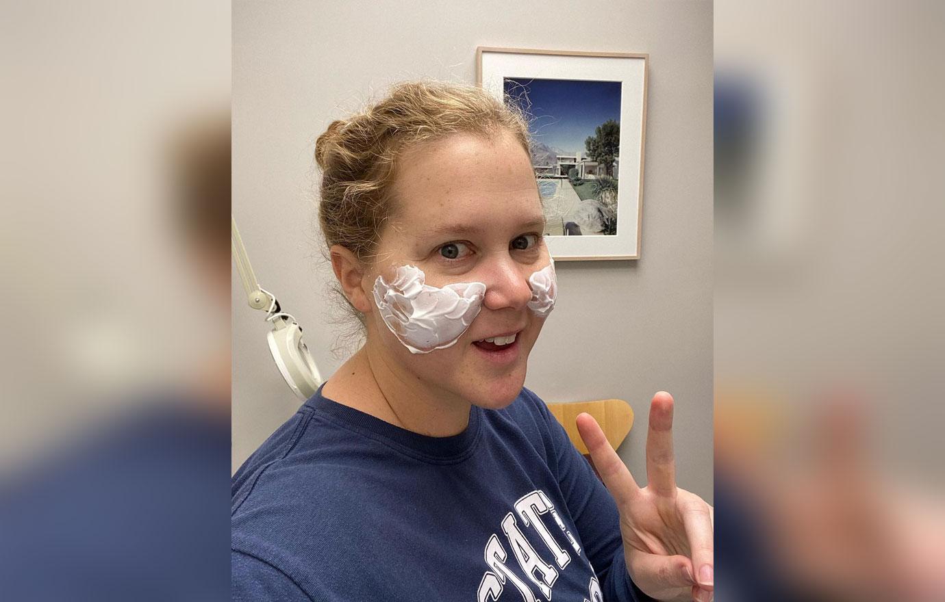 Amy Schumer Has Face Fillers Dissolved Reveals She Got Liposuction 