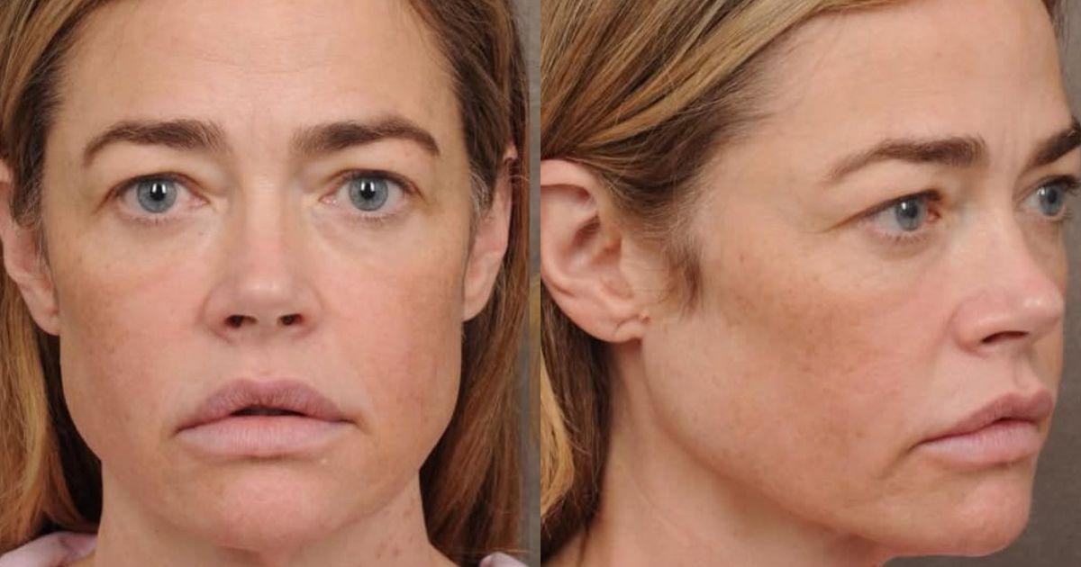 Denise Richards' Plastic Surgery