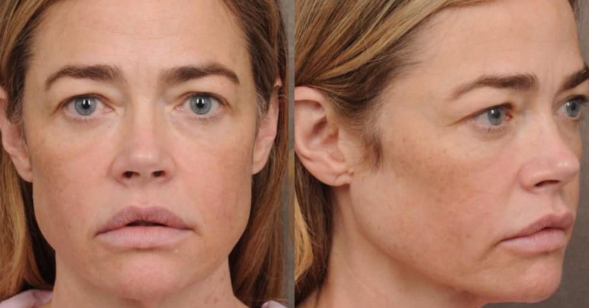Denise Richards Debuts 'Stunning' PostSurgery Look Declares(02)
