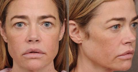 Denise Richards' Plastic Surgery