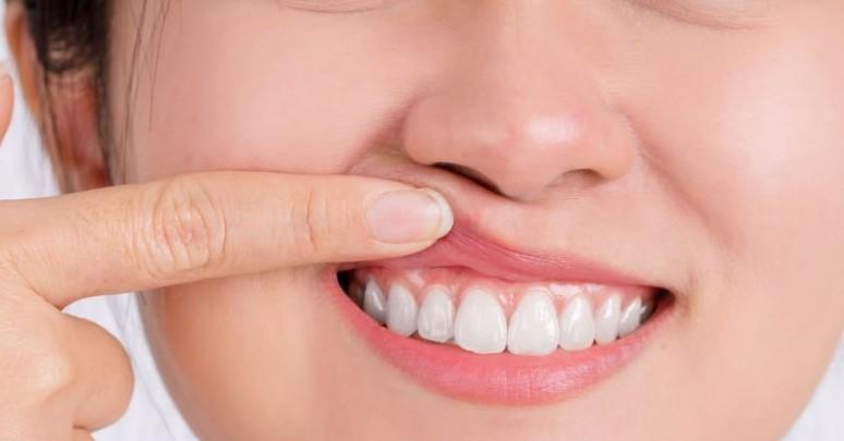 all natural remedies gum disease pp