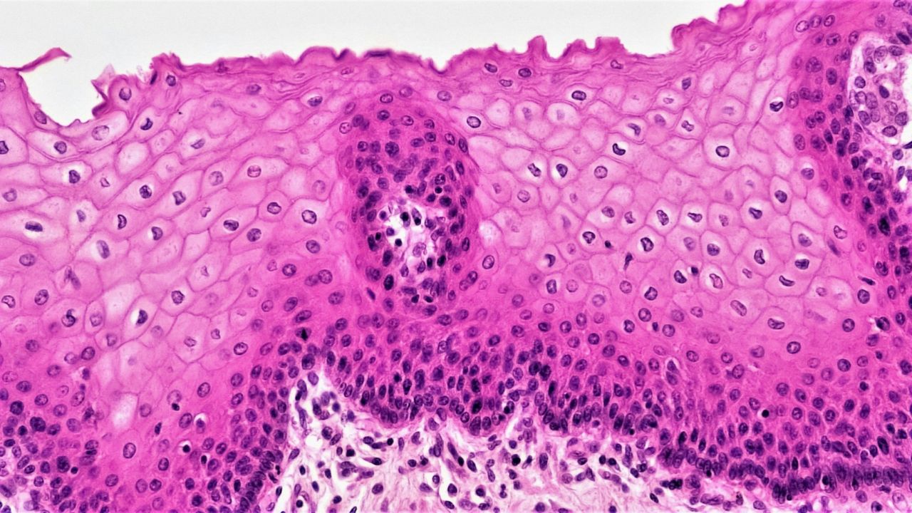 Reworked tapeworm drug shows promise for endometriosis